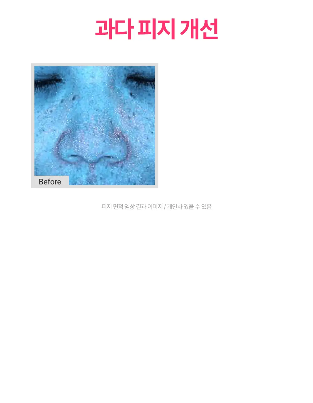 [트러블 피부 추천/붉은기 진정 앰플] 제로이드 핌프로브 카밍 앰플 30ml 상세페이지 16
